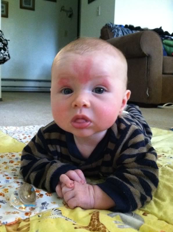 Stork bites anyone? BabyCenter